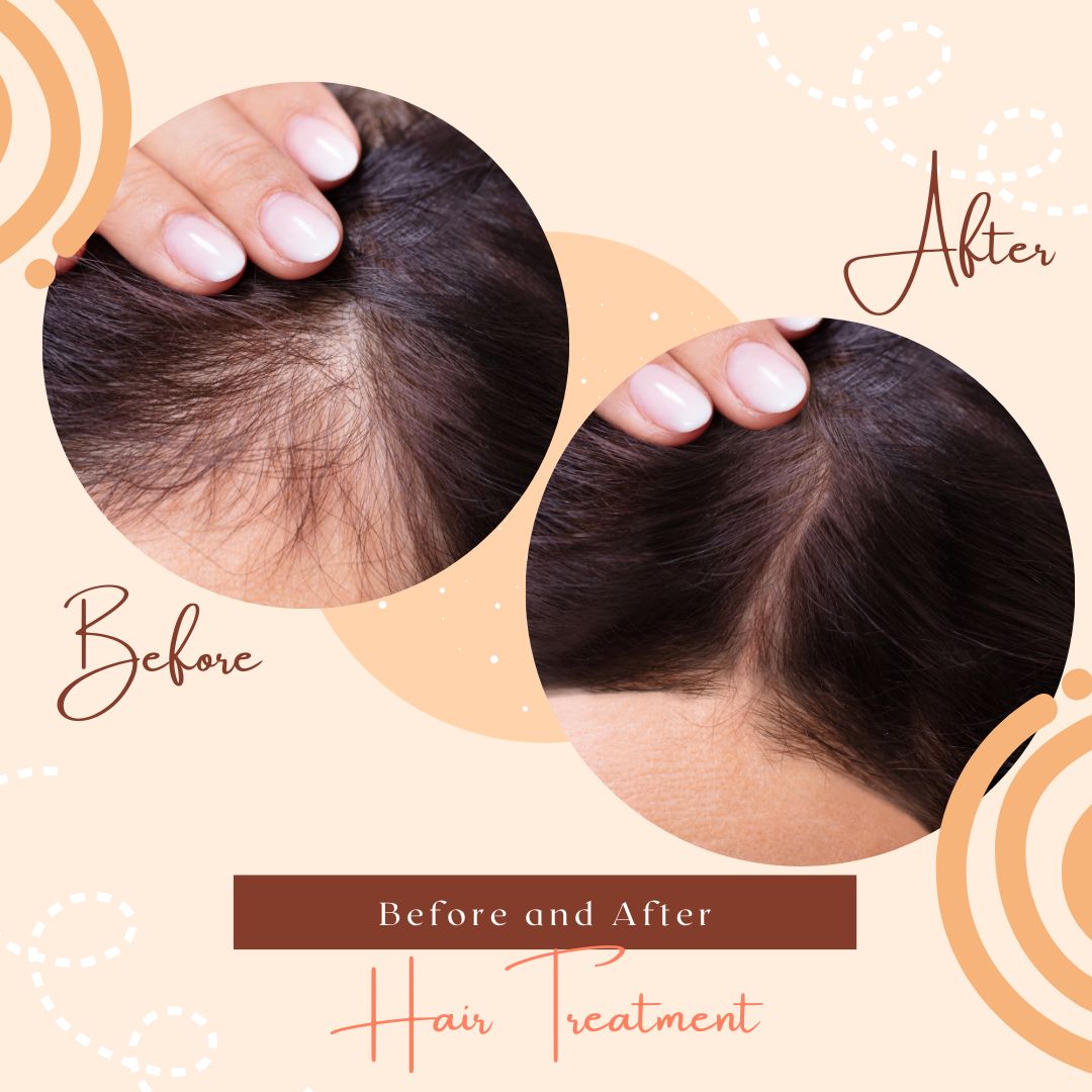 Laser Hair Removal in Adampur